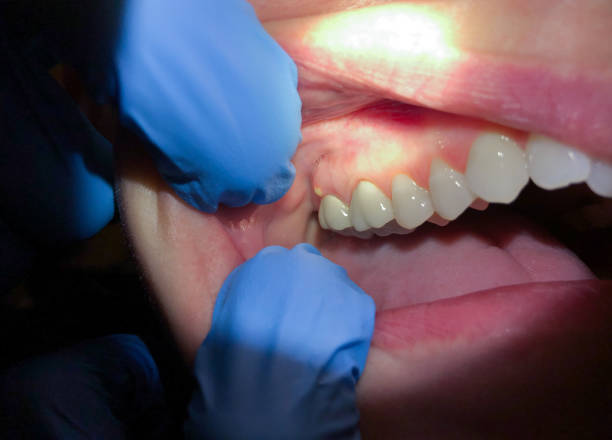 Best Emergency Dental Care for Abscessed Tooth in Inverness, FL